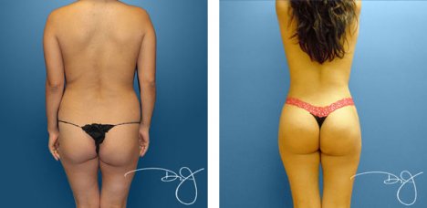 Achieve Natural Results With a Brazilian Butt Lift - Los Angeles, CA