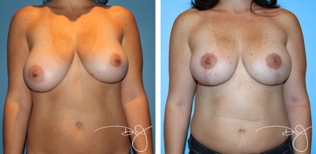 breast lift in beverly hills
