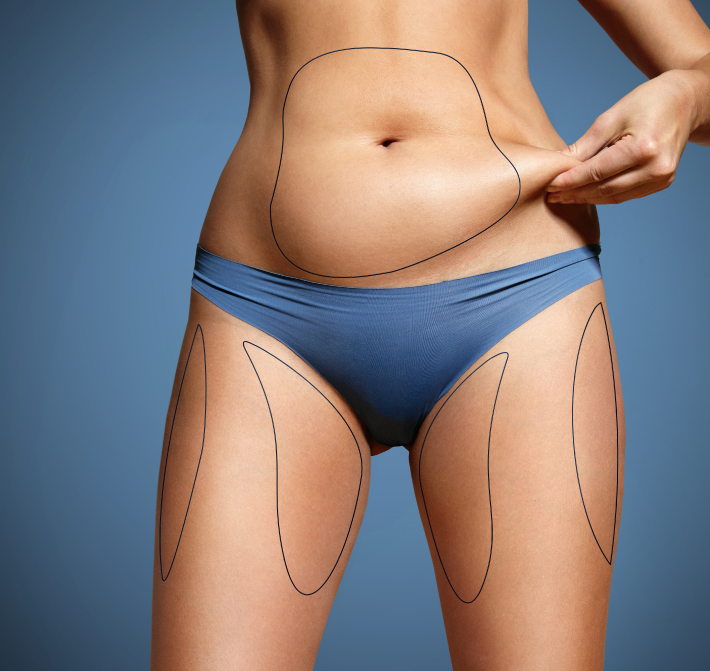 LIPOSUCTION ALTERNATIVES