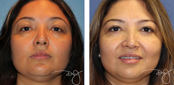 10-blepharoplasty3